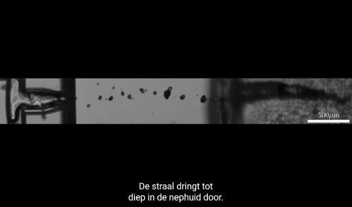 naalsloos injecteren - still uit video die toont hoe een straaltje medicatievloeistof lasergestuurd door de huid heen wordt geschoten