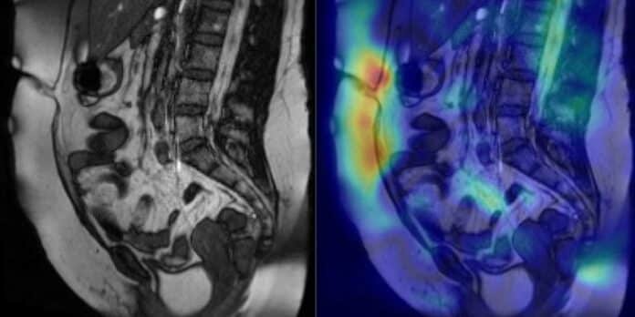 Cine-MRI-beeld van verklevingen in de buik