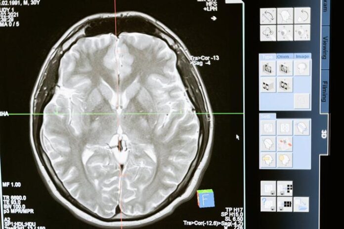 parkinson, diepe hersenstimulatie